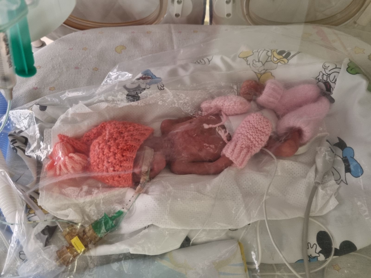 288 dienos ligoninėje ir 30 operacijų: ypatinga ankstukės Kamilės istorija